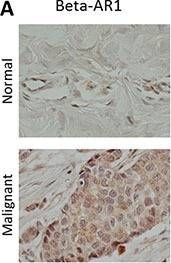 Fig.1.A showing Immunohistochemistry in a Homo sapiens (Human) sample from the publication: Use of non-selective β-blockers is associated with decreased tumor proliferative indices in early stage breast cancer.