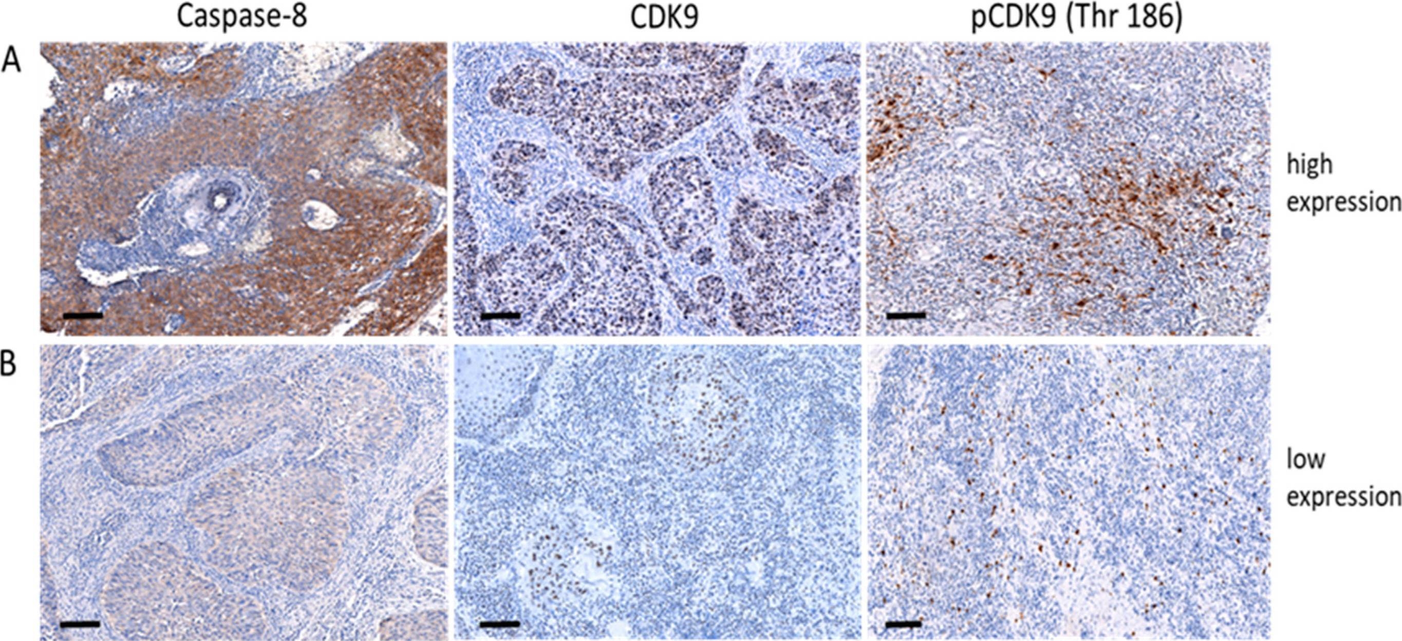 Fig.1.A showing Immunohistochemistry from the publication: Prognostic Impact of Caspase-8, CDK9 and Phospho-CDK9 (Thr 186) Expression in Patients with Uterine Cervical Cancer Treated with Definitive Chemoradiation and Brachytherapy.
