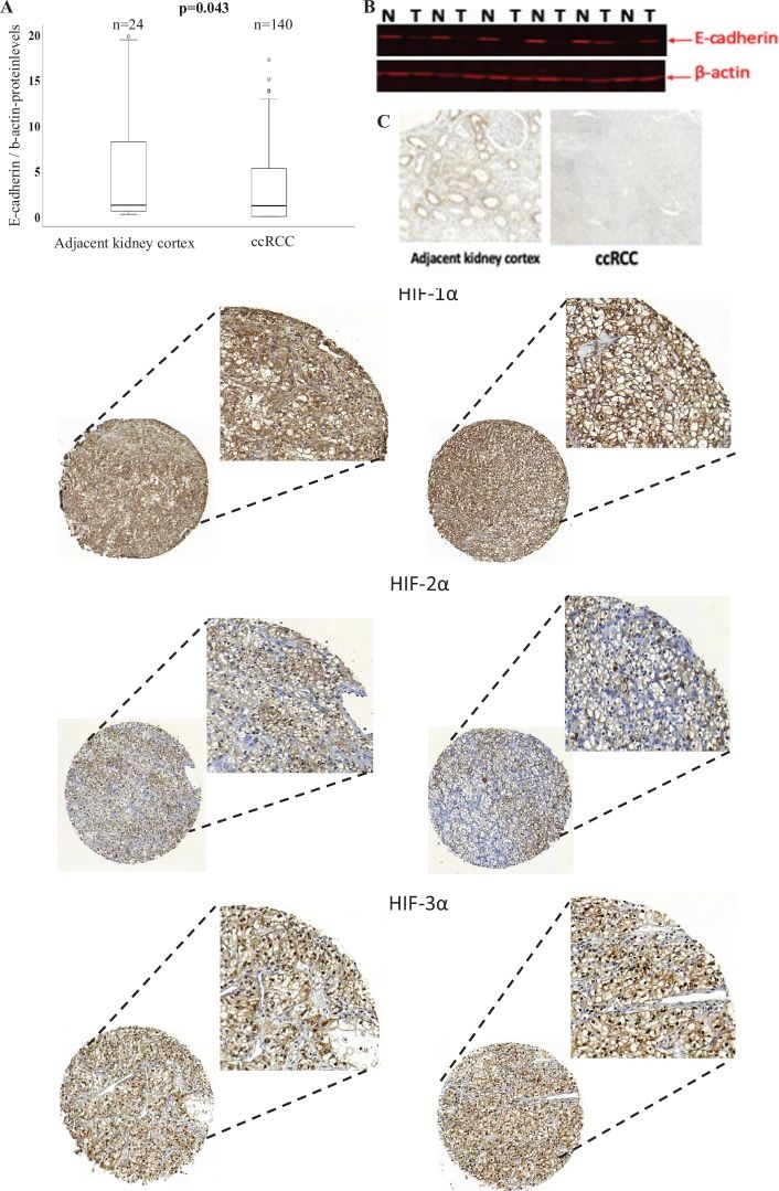 Fig.1.A showing Immunohistochemistry from the publication: pVHL status in clear cell renal cell carcinoma regulates HIF-α and E-cadherin expression levels and their implications for tumor progression.
