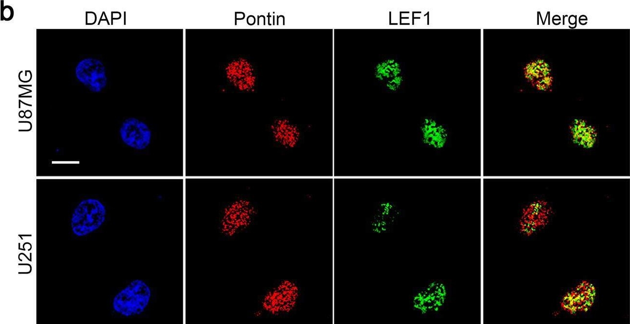 Fig.6.B showing Immunocytochemistry-immunofluorescence in a Homo sapiens (Human) sample from the publication: Recruitment of LEF1 by Pontin chromatin modifier amplifies TGFBR2 transcription and activates TGFβ/SMAD signalling during gliomagenesis.