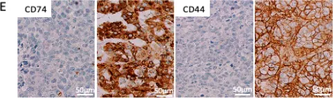 Fig.2.E showing Immunohistochemistry in a Homo sapiens (Human) sample from the publication: CD74 and CD44 Expression on CTCs in Cancer Patients with Brain Metastasis.