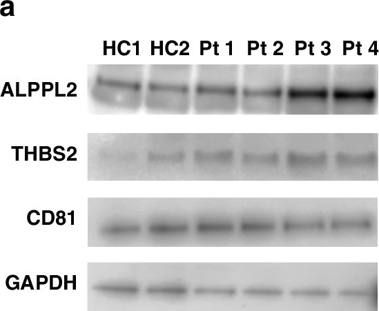 Fig.1.A showing Western Blotting from the publication: Exosomal ALPPL2 and THBS2 as biomarkers for early detection and disease monitoring of pancreatic ductal adenocarcinoma.