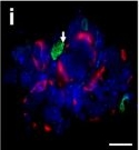 Macrophages orchestrate breast cancer early dissemination and metastasis.