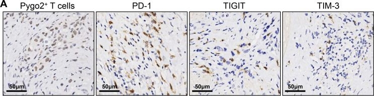 Fig.4.A showing Immunohistochemistry in a Homo sapiens (Human) sample from the publication: Pygo2+ T cells possess immunosuppressive features and inferior immunotherapeutic response in gastric cancer.