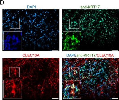 Fig.5.D showing Immunohistochemistry-immunofluorescence in a Homo sapiens (Human) sample from the publication: GlycoChat Uncovers Glycan-Lectin Circuits in the Tumor Microenvironment of Pancreatic Cancer.