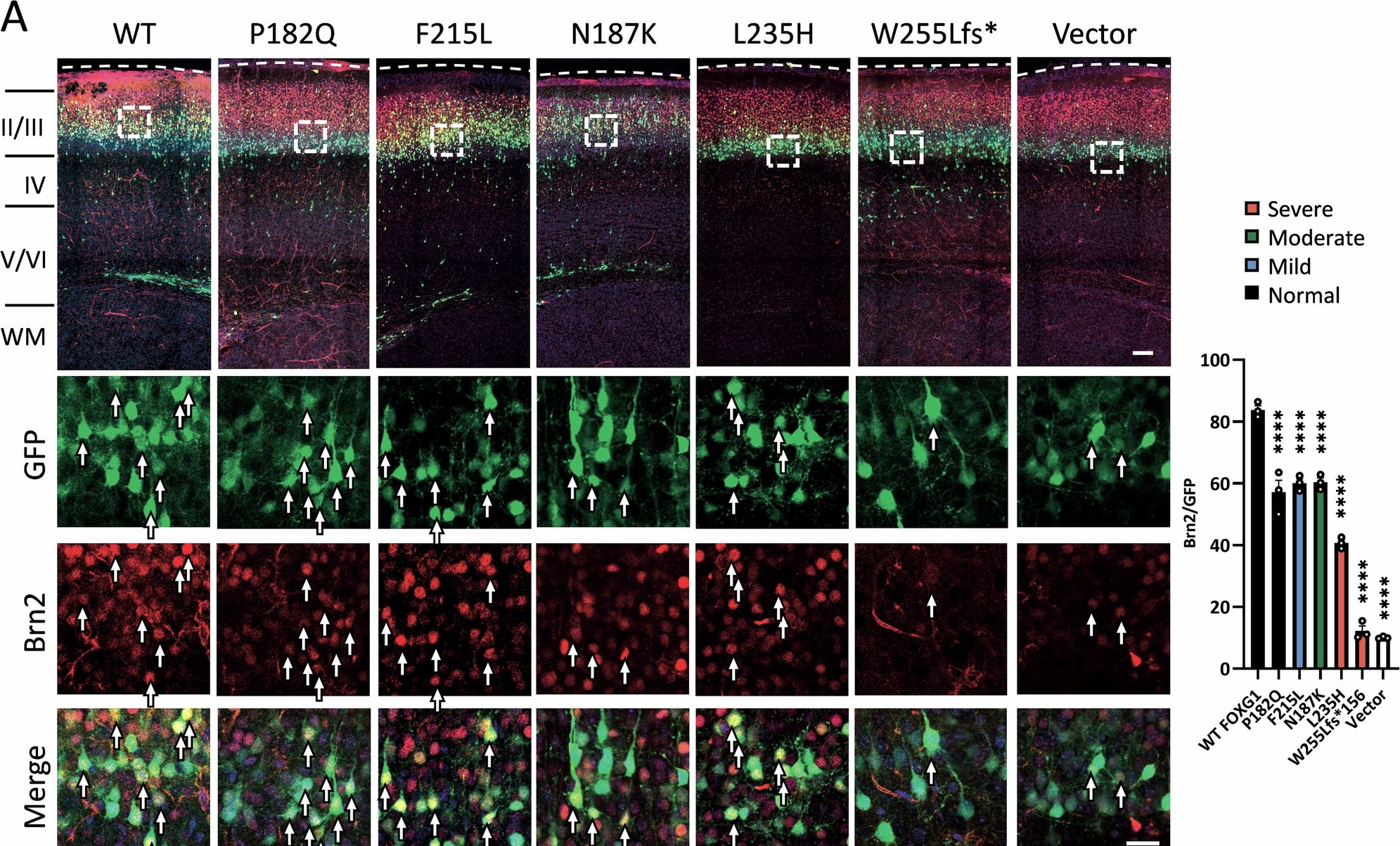 Fig.4.A showing Immunohistochemistry-immunofluorescence from the publication: Functional defects in FOXG1 variants predict the severity of brain anomalies in FOXG1 syndrome.