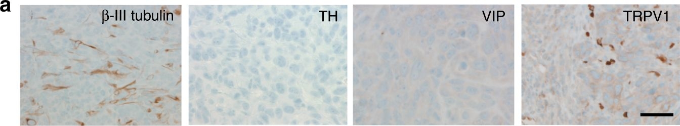 Fig.4.A showing Immunohistochemistry in a Homo sapiens (Human) sample from the publication: Cancer exosomes induce tumor innervation.
