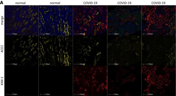 Fig.1.A showing Immunohistochemistry-immunofluorescence from the publication: Levels of circulating kidney injury markers and IL-10 identify non-critically ill patients with COVID-19 at risk of death.