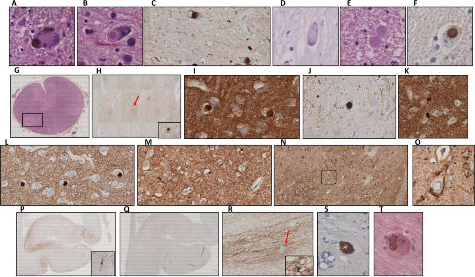 Fig.4.A showing Immunohistochemistry in a Homo sapiens (Human) sample from the publication: Norovirus Intestinal Infection and Lewy Body Disease in an Older Patient with Acute Cognitive Impairment.
