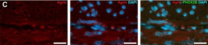 Fig.5.C showing Immunohistochemistry-immunofluorescence in a Homo sapiens (Human) sample from the publication: Perlecan, CollagenXVIII, and Agrin Expression in Normo-, Hypo-, and Aganglionic Segments in Hirschsprung's Disease.