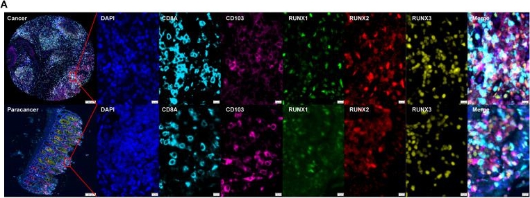 Fig.2.A showing Immunohistochemistry-immunofluorescence in a Homo sapiens (Human) sample from the publication: Novel biomarkers: the RUNX family as prognostic predictors in colorectal cancer.