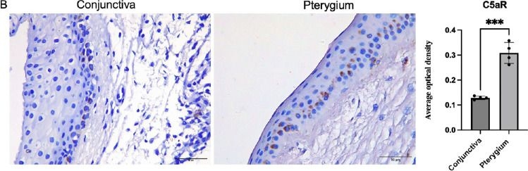 Fig.6.B showing Immunohistochemistry in a Homo sapiens (Human) sample from the publication: Complement C5a Promotes Epithelial-Mesenchymal Transition in Pterygium via C5aR Activation.
