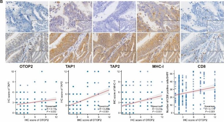 Fig.8.B showing Immunohistochemistry from the publication: Determination of the Immunomodulatory Role of OTOP2 in Colon Adenocarcinoma.
