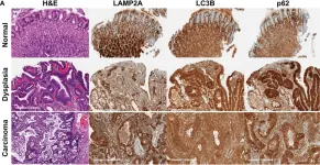 Fig.1.A showing Immunohistochemistry from the publication: Autophagic Heterogeneity in Gastric Adenocarcinoma.