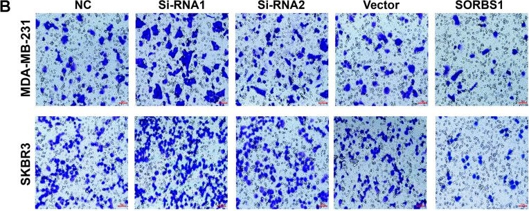 Fig.4.B showing Immunohistochemistry in a Homo sapiens (Human) sample from the publication: SORBS1 inhibits epithelial to mesenchymal transition (EMT) of breast cancer cells by regulating PI3K/AKT signaling and macrophage phenotypic polarization.