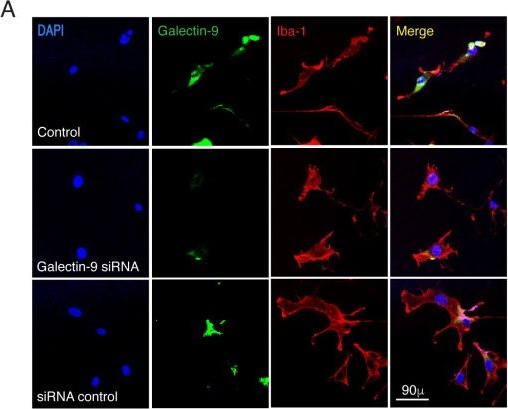 Fig.5.A showing Immunocytochemistry-immunofluorescence in a Homo sapiens (Human) sample from the publication: Interrogation of glioma immune microenvironment identifies a non-canonical role for microglial Galectin-9 in tumor cell adhesion and phagocytosis.