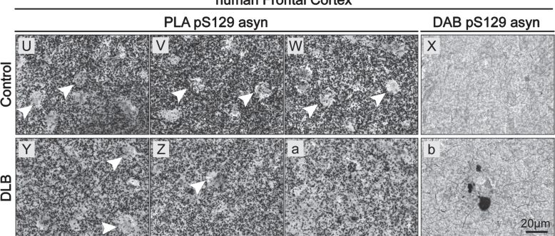 Fig.5.U showing Immunohistochemistry in a Homo sapiens (Human) sample from the publication: Specific Detection of Physiological S129 Phosphorylated α-Synuclein in Tissue Using Proximity Ligation Assay.