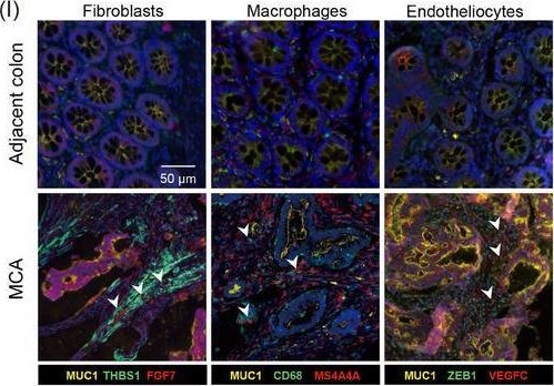 Fig.8.I showing Immunohistochemistry-immunofluorescence from the publication: Integrating single-cell and spatial analysis reveals MUC1-mediated cellular crosstalk in mucinous colorectal adenocarcinoma.