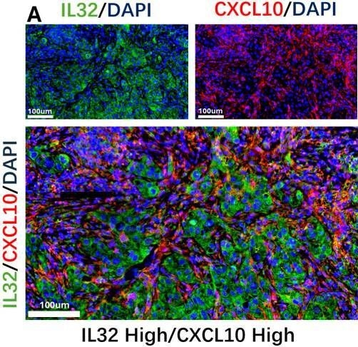 Fig.7.D showing Immunohistochemistry-immunofluorescence from the publication: Subtype-specific NK cell-TAM interactions drive a novel prognostic signature in HNSCC.