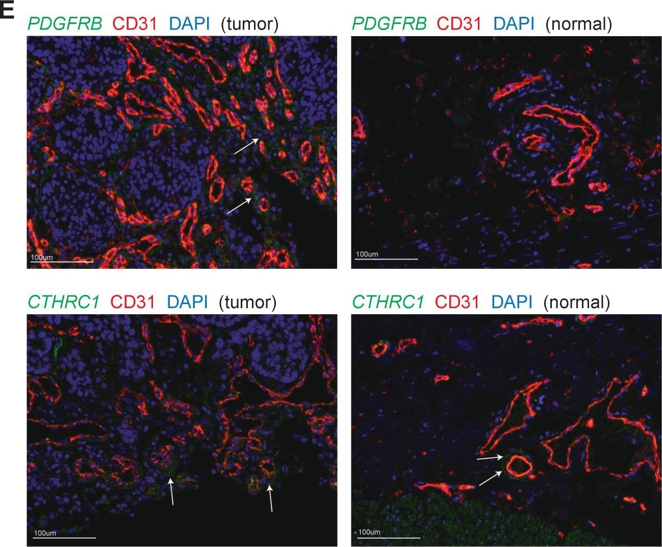 Fig.5.E showing Immunohistochemistry-immunofluorescence in a Homo sapiens (Human) sample from the publication: Single-cell landscape reveals active cell subtypes and their interaction in the tumor microenvironment of gastric cancer.