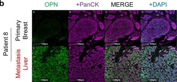 Fig.8.B showing Immunohistochemistry-immunofluorescence in a Homo sapiens (Human) sample from the publication: Osteopontin is a therapeutic target that drives breast cancer recurrence.