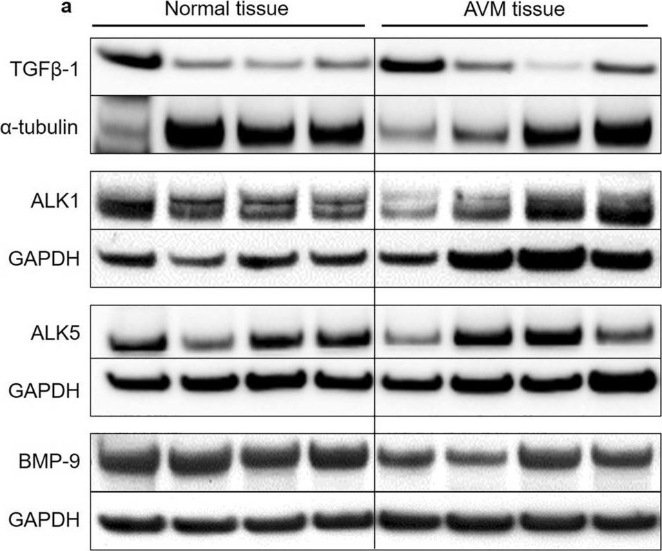 Fig.2.A showing Western Blotting in a Homo sapiens (Human) sample from the publication: Extracranial arteriovenous malformations demonstrate dysregulated TGF-β/BMP signaling and increased circulating TGF-β1.