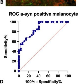 Fig.3.B showing Immunohistochemistry-immunofluorescence in a Homo sapiens (Human) sample from the publication: Diagnostic Potential of Combined Skin Morphometric Analysis and Salivary Alpha-Synuclein Oligomers in Parkinson's Disease.
