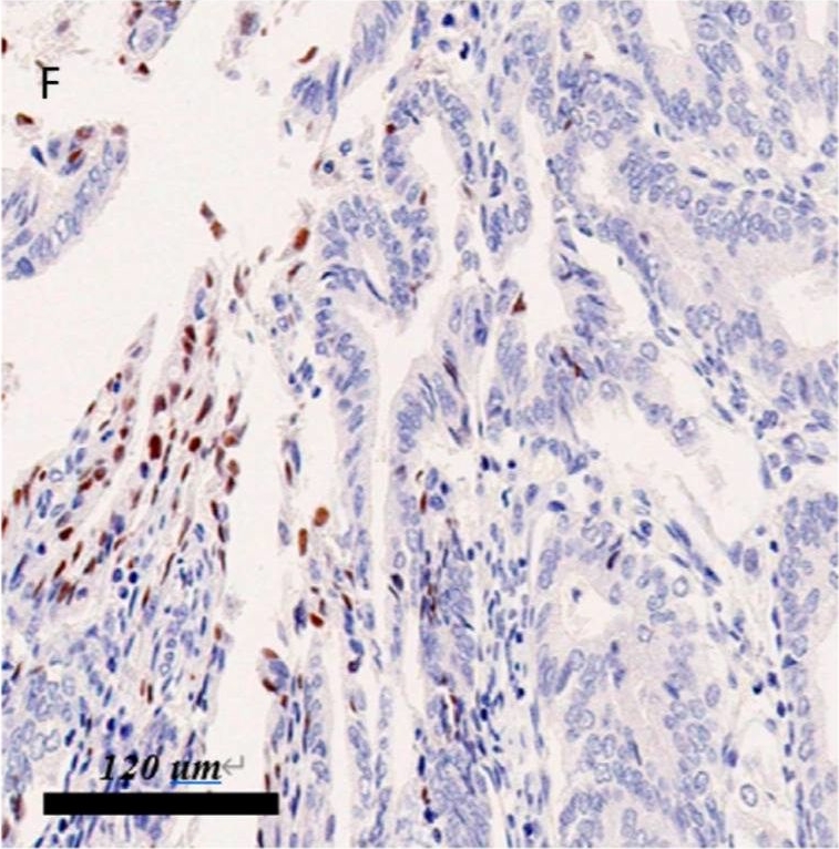 Fig.1.F showing Immunohistochemistry in a Homo sapiens (Human) sample from the publication: Expression of the Hippo Pathway Core Components in Endometrial Cancer and Its Association with Clinicopathologic Features.