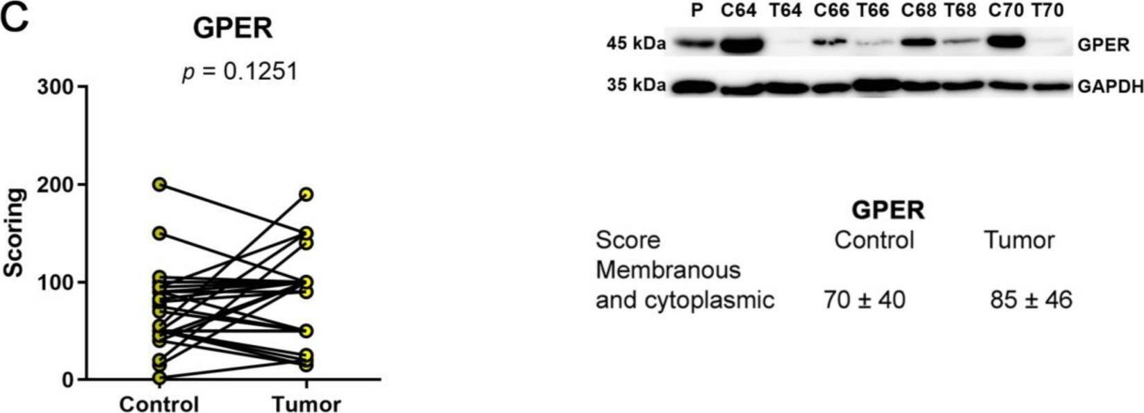 Fig.5.C showing Western Blotting from the publication: The Co-Expression of Estrogen Receptors ERα, ERβ, and GPER in Endometrial Cancer.