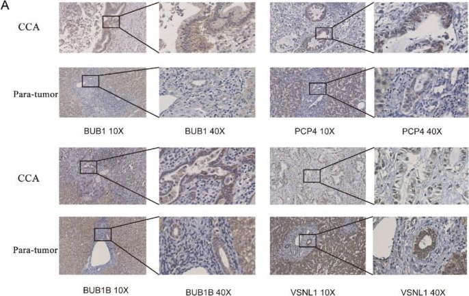 Fig.8.A showing Immunohistochemistry from the publication: Characteristic Analysis of Featured Genes Associated with Cholangiocarcinoma Progression.