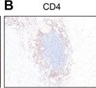 Fig.4.B showing Immunohistochemistry from the publication: Comprehensive analysis based on tertiary lymphoid structures and tumor budding predicts survival rates in colorectal cancer patients with synchronous liver metastases.