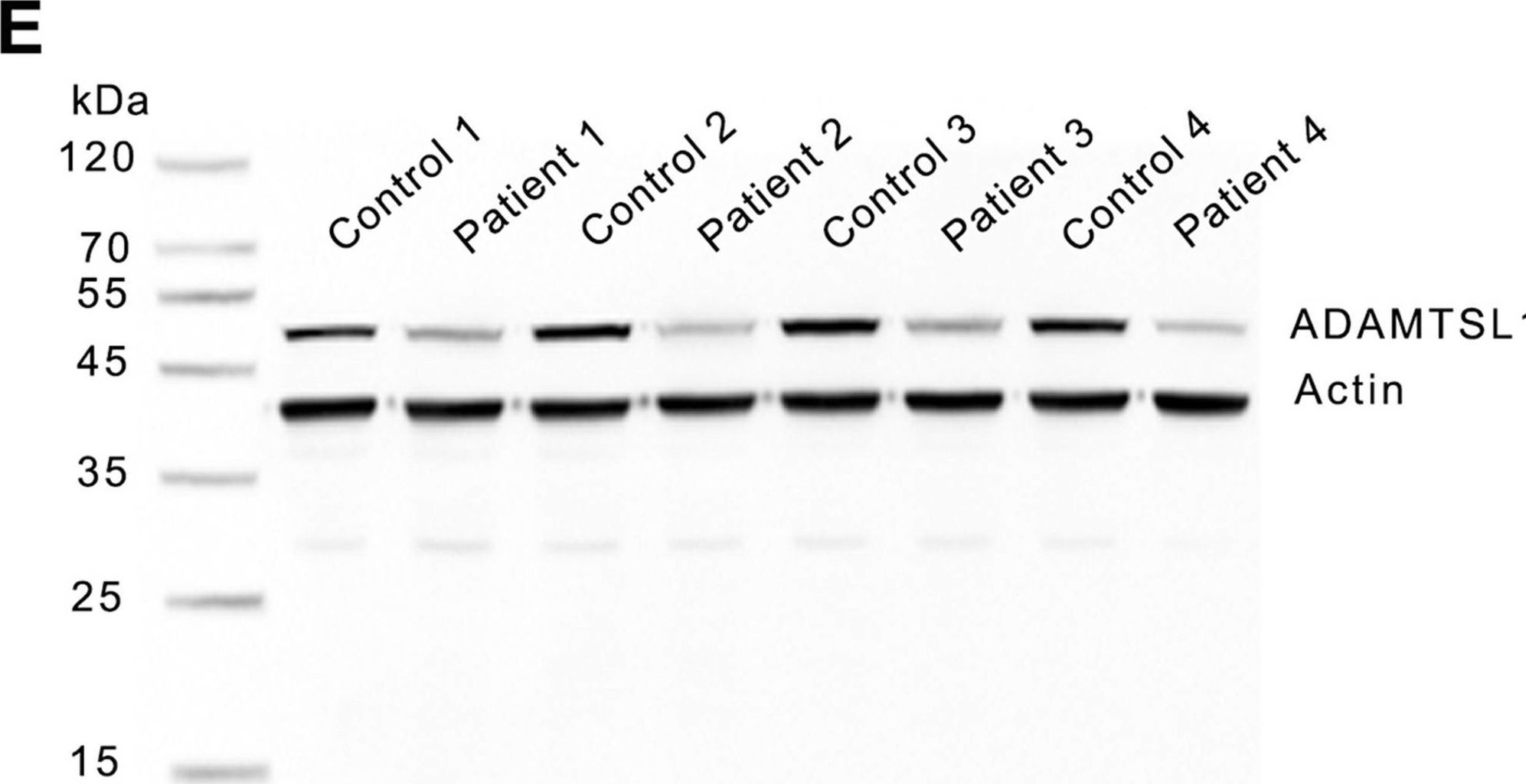 Fig.3.E showing Western Blotting in a Homo sapiens (Human) sample from the publication: Intracranial aneurysm's association with genetic variants, transcription abnormality, and methylation changes in ADAMTS genes.