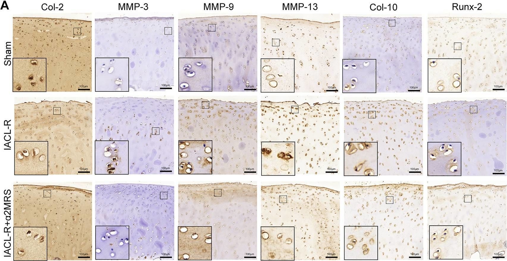 Fig.9.A showing Immunohistochemistry in a Homo sapiens (Human) sample from the publication: α2-macroglobulin-rich serum as a master inhibitor of inflammatory factors attenuates cartilage degeneration in a mini pig model of osteoarthritis induced by "idealized" anterior cruciate ligament reconstruction.