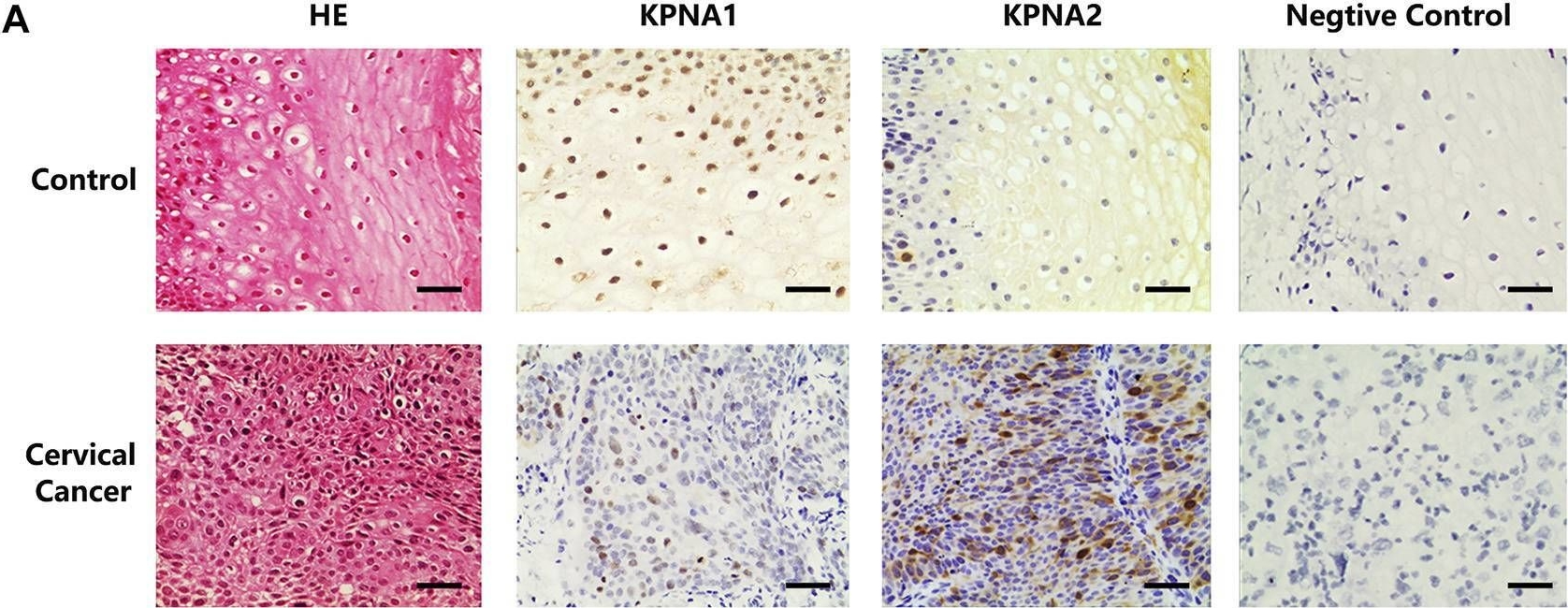 Fig.1.A showing Immunohistochemistry from the publication: Decreased Expression of Karyopherin-α 1 is Related to the Malignant Degree of Cervical Cancer and is Critical for the Proliferation of Hela Cells.