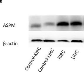 Fig.7.B showing Western Blotting in a Homo sapiens (Human) sample from the publication: ASPM Is a Prognostic Biomarker and Correlates With Immune Infiltration in Kidney Renal Clear Cell Carcinoma and Liver Hepatocellular Carcinoma.