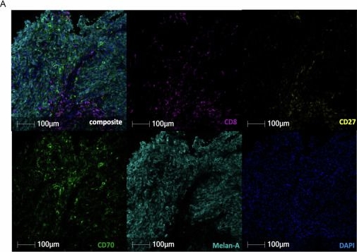 Fig.1.A showing Immunohistochemistry-immunofluorescence in a Homo sapiens (Human) sample from the publication: Soluble CD27 differentially predicts resistance to anti-PD1 alone but not with anti-CTLA-4 in melanoma.
