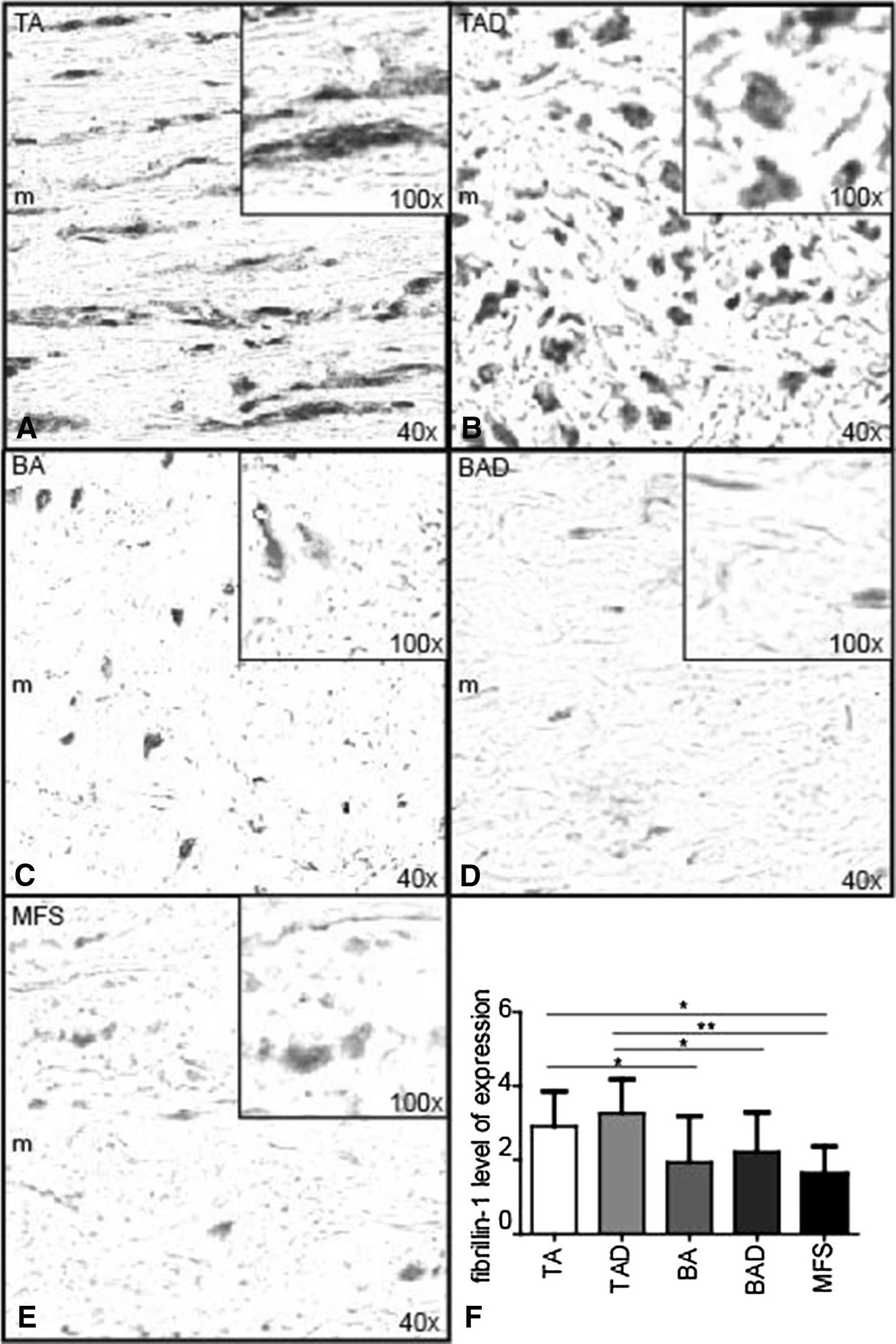 Fig.2.A showing Immunohistochemistry in a Homo sapiens (Human) sample from the publication: Histopathology of aortic complications in bicuspid aortic valve versus Marfan syndrome: relevance for therapy?