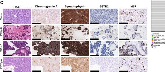 Fig.6.C showing Immunohistochemistry in a Homo sapiens (Human) sample from the publication: Expanded GEP-NET organoid culture for personalized therapy evaluation.