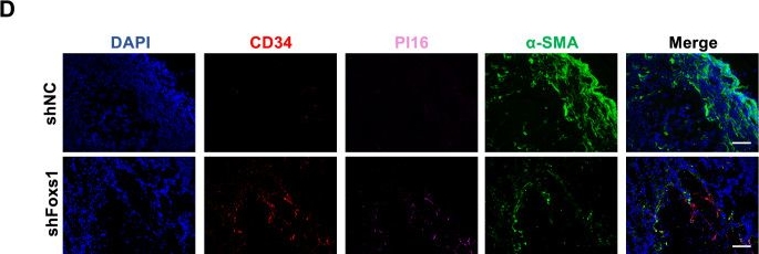 Fig.5.D showing Immunohistochemistry-immunofluorescence in a Homo sapiens (Human) sample from the publication: Foxs1-mediated transformation of CD34+ fibroblast to myCAFs promotes tumor growth.