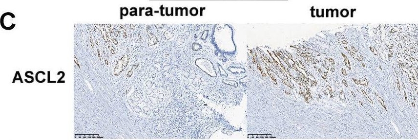Fig.2.C showing Immunohistochemistry from the publication: Achaete-scute complex-like 2 regulated inflammatory mechanism through Toll-like receptor 4 activating in stomach adenocarcinoma.