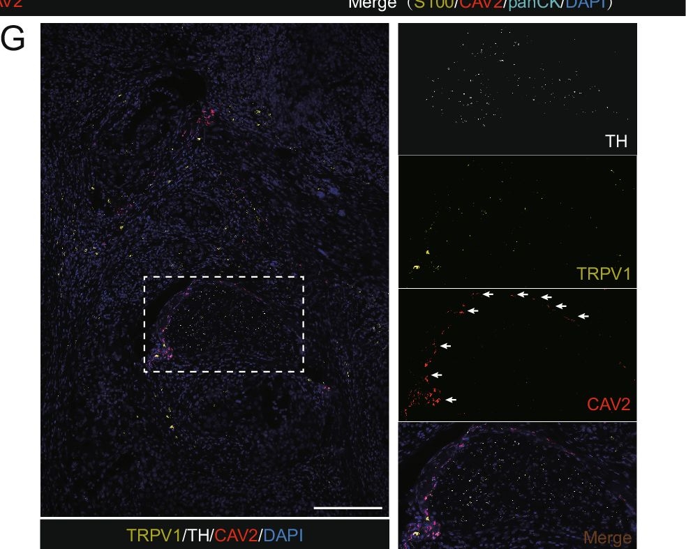 Fig.1.G showing Immunohistochemistry-immunofluorescence in a Homo sapiens (Human) sample from the publication: CAV2-expressing nerves induce metabolic switch toward mitochondrial oxidative phosphorylation to promote cancer stemness.