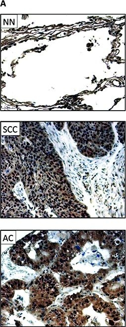 Fig.1.A showing Immunohistochemistry-paraffin in a Homo sapiens (Human) sample from the publication: CXCR6 expression in non-small cell lung carcinoma supports metastatic process via modulating metalloproteinases.