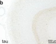 Fig.5.B showing Immunohistochemistry in a Homo sapiens (Human) sample from the publication: Frequency of mixed neuropathologies in individuals with down syndrome with and without Alzheimer's dementia.
