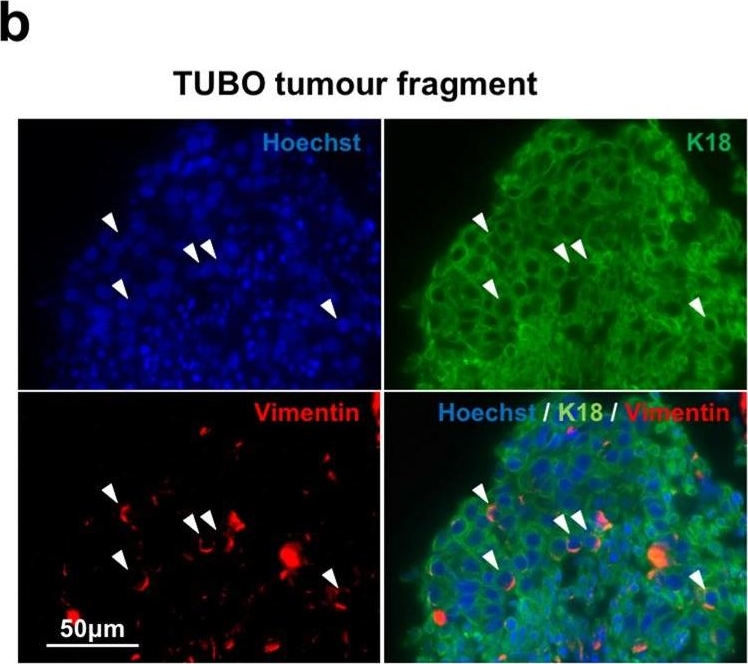 Tumour cell invasiveness and response to chemotherapeutics in adipocyte invested 3D engineered anisotropic collagen scaffolds.