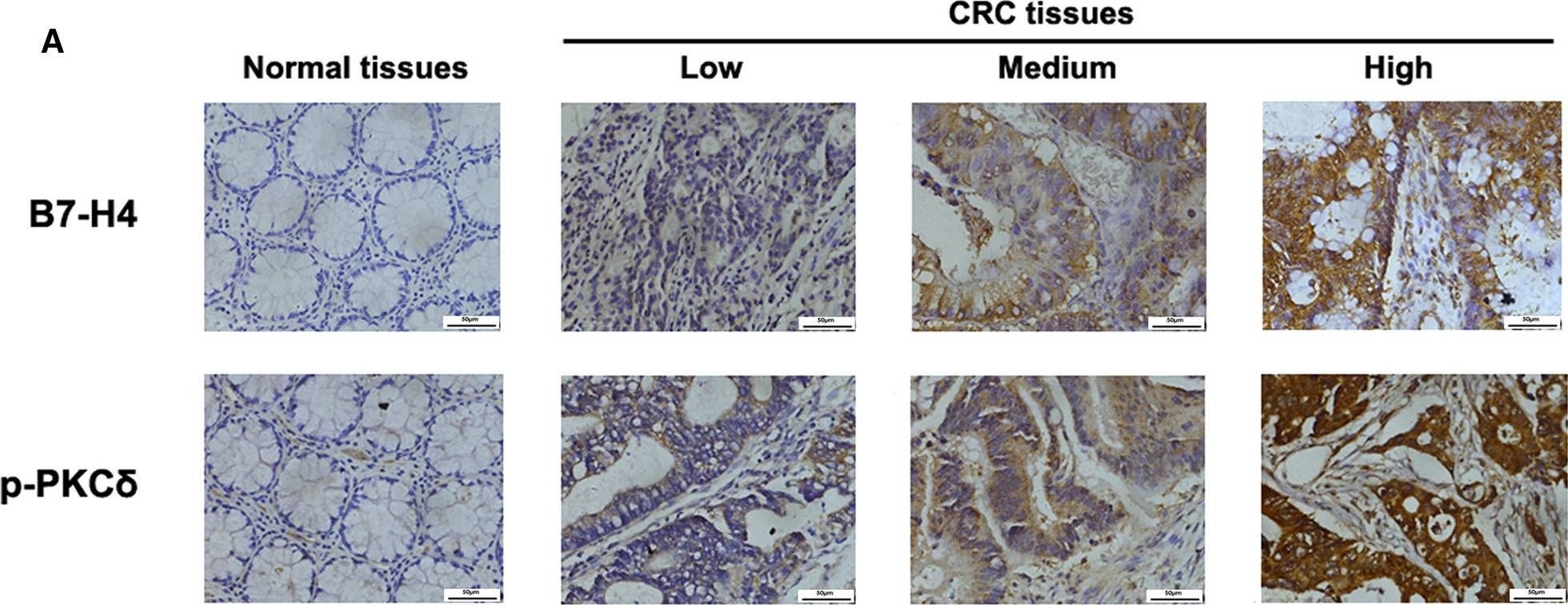Fig.1.A showing Immunohistochemistry from the publication: B7-H4 expression is upregulated by PKCδ activation and contributes to PKCδ-induced cell motility in colorectal cancer.
