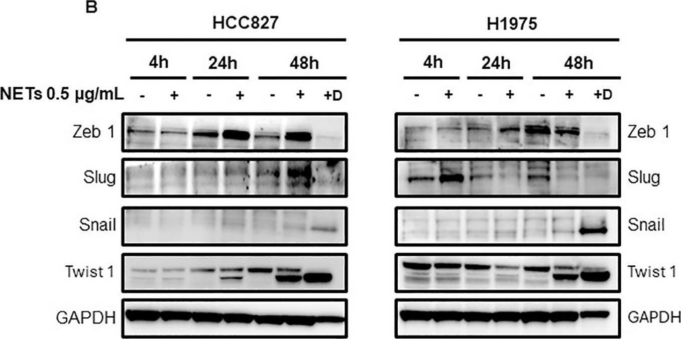 Fig.6.B showing Western Blotting in a Homo sapiens (Human) sample from the publication: Dynamic roles of neutrophil extracellular traps in cancer cell adhesion and activation of Notch 1-mediated epithelial-to-mesenchymal transition in EGFR-driven lung cancer cells.