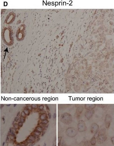 Fig.3.D showing Immunohistochemistry from the publication: Global loss of a nuclear lamina component, lamin A/C, and LINC complex components SUN1, SUN2, and nesprin-2 in breast cancer.