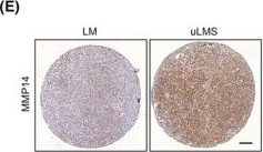 Fig.2.E showing Immunohistochemistry in a Homo sapiens (Human) sample from the publication: MMP14 expression and collagen remodelling support uterine leiomyosarcoma aggressiveness.