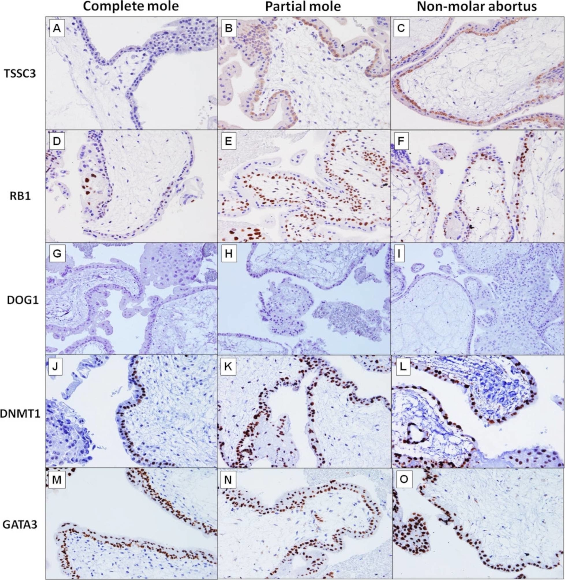 Fig.2.A showing Immunohistochemistry from the publication: Diagnostic Utility of TSSC3 and RB1 Immunohistochemistry in Hydatidiform Mole.