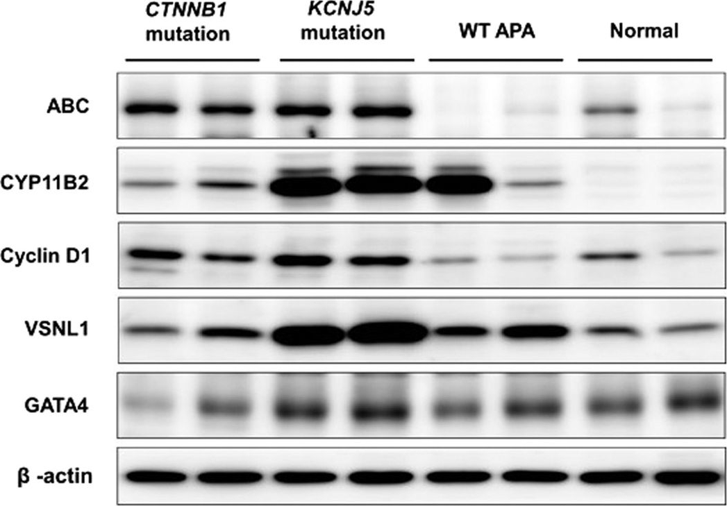 Fig.3.A showing Western Blotting in a Homo sapiens (Human) sample from the publication: The prevalence of CTNNB1 mutations in primary aldosteronism and consequences for clinical outcomes.